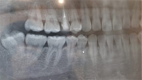 親知らずと歯並びの悪さの関係性とは？