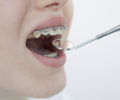 八重歯の矯正に犬歯の抜歯は必要？