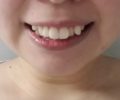 八重歯をそのままにしておくことによるトラブルとは？