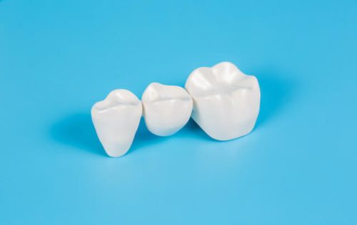 セラミックの歯が割れた原因や保証について解説