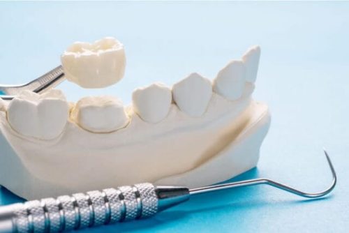 セラミックの歯にするやり方を解説！治療の流れも紹介