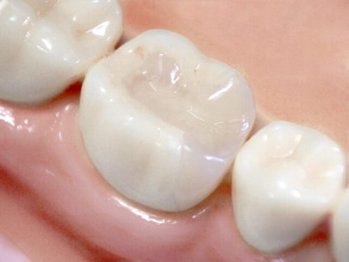 セラミックの歯でホワイトニングしても大丈夫？セラミックの黄ばみを取る方法