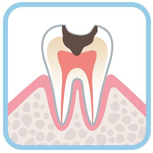 虫歯の早期発見には定期健診が重要です。