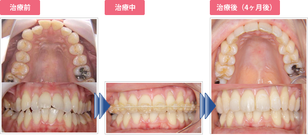 【症例付】部分矯正で出っ歯を4ヶ月で矯正